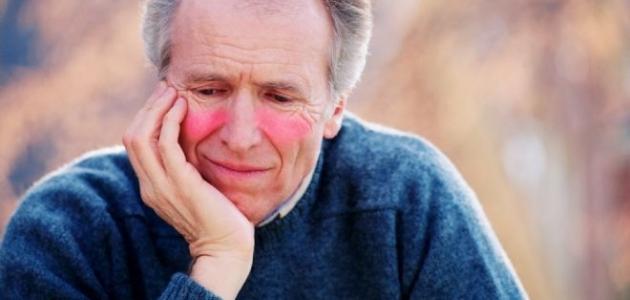 علاج الذئبة الحمراء بالطب البديل علاج الذئبة الحمراء بالطب البديل