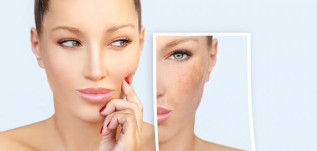 علاج الكلف علاج الكلف