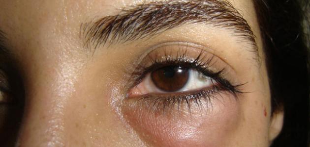 علاج الهالات السوداء بالحقن علاج الهالات السوداء بالحقن