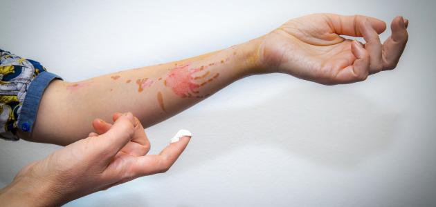 علاج حروق الزيت علاج حروق الزيت
