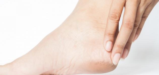 علاج خشونة وتشقق القدمين