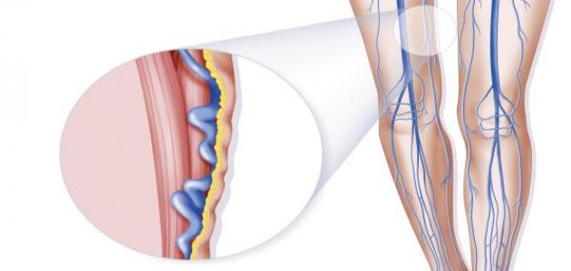 علاج طبيعي لدوالي الساقين