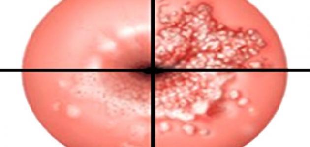 علاج قرحة الرحم