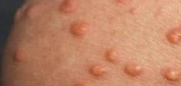 علاج مرض داء اللؤلؤ علاج مرض داء اللؤلؤ