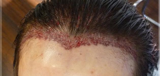 عيوب زراعة الشعر عيوب زراعة الشعر