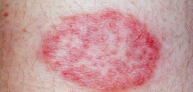 فطريات الجلد الحمراء