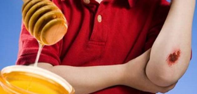 فوائد العسل للحروق فوائد العسل للحروق