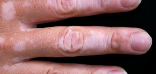 فوائد القطران للبهاق فوائد القطران للبهاق