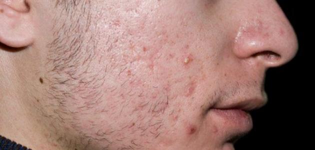 فوائد المعجون لحب الشباب