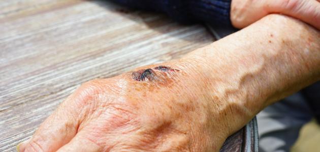 كيفية إزالة آثار الحروق من اليد