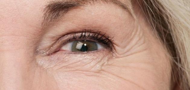 كيفية إزالة التجاعيد تحت العين كيفية إزالة التجاعيد تحت العين