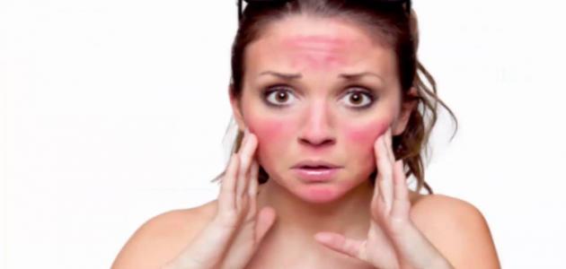 كيفية التخلص من آثار أشعة الشمس كيفية التخلص من آثار أشعة الشمس