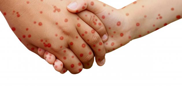 كيفية التخلص من اثار جدري الماء كيفية التخلص من اثار جدري الماء