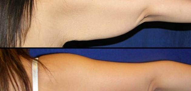 كيفية التخلص من ترهلات الجسم كيفية التخلص من ترهلات الجسم