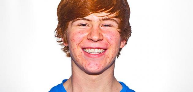 كيفية التخلص من حب الشباب كيفية التخلص من حب الشباب