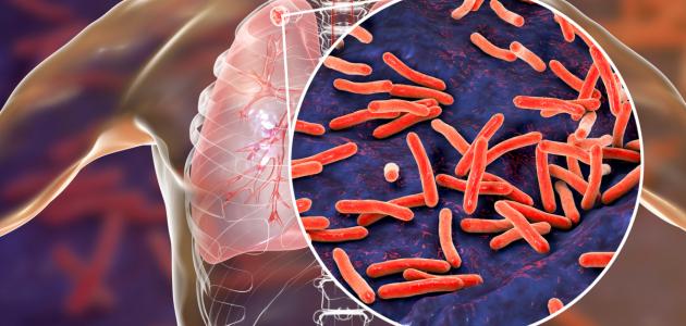 كيفية تشخيص مرض السل كيفية تشخيص مرض السل