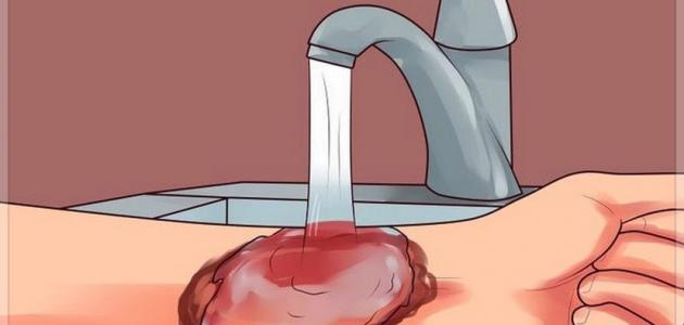 كيفية علاج الحروق كيفية علاج الحروق