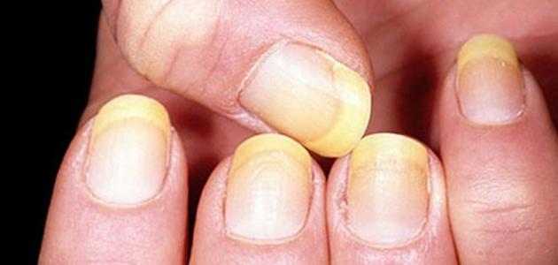 كيفية علاج فطريات الأظافر كيفية علاج فطريات الأظافر