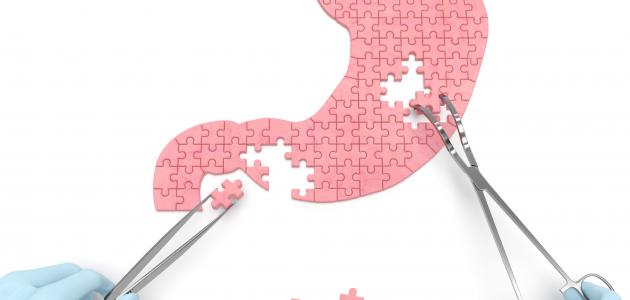 كيفية علاج قرحة المعدة كيفية علاج قرحة المعدة