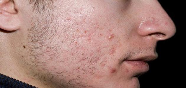كيف أتخلص من البشرة الدهنية كيف أتخلص من البشرة الدهنية
