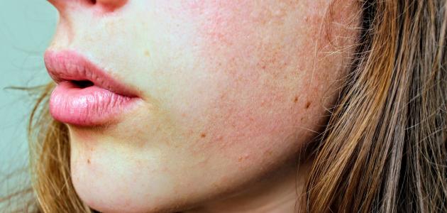 كيف أزيل الحبوب من وجهي في يوم كيف أزيل الحبوب من وجهي في يوم