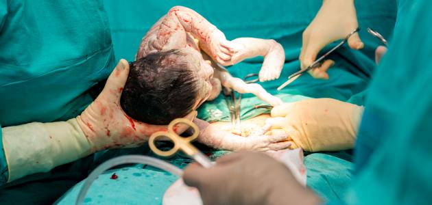 كيف تكون العملية القيصرية كيف تكون العملية القيصرية
