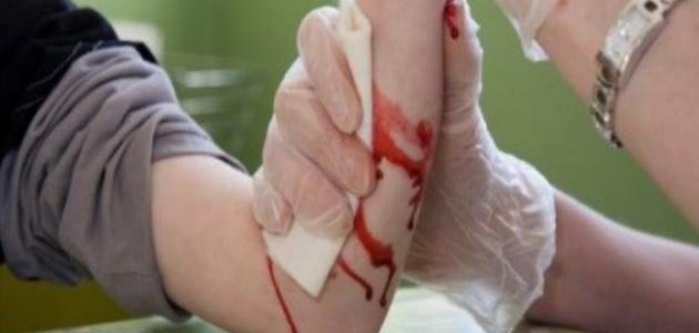 كيف توقف نزيف الجرح كيف توقف نزيف الجرح
