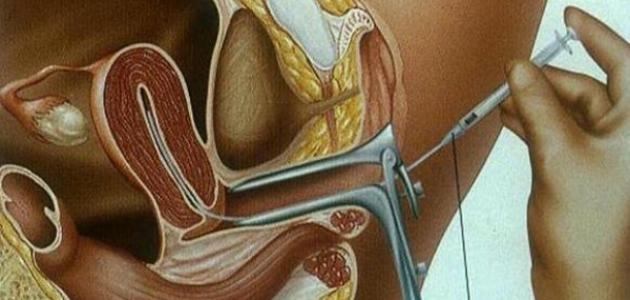 كيف يتم التلقيح الصناعي كيف يتم التلقيح الصناعي