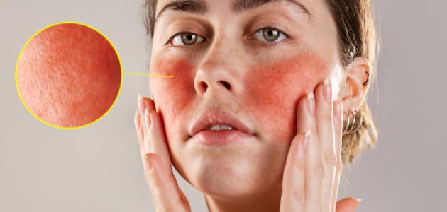 كيف يعالج مرض الوردية كيف يعالج مرض الوردية