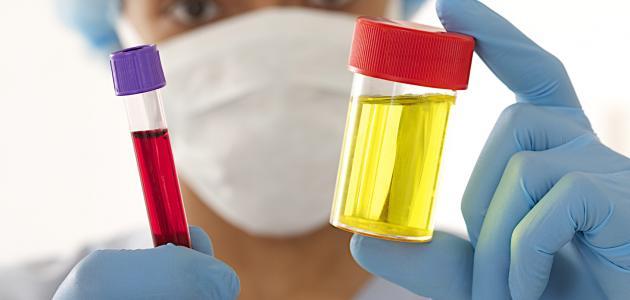 ما أسباب الزلال في البول ما أسباب الزلال في البول