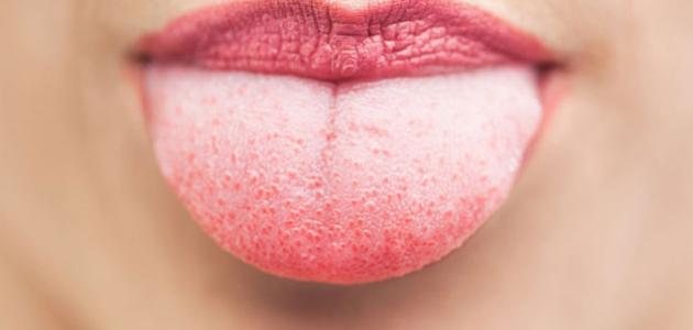 ما أسباب بياض اللسان ما أسباب بياض اللسان