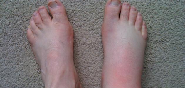 ما أسباب تورم القدمين ما أسباب تورم القدمين