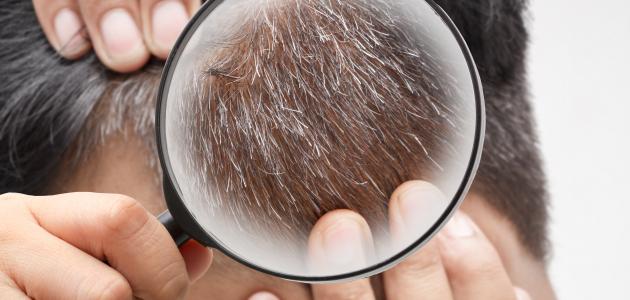 ما أسباب شيب الشعر المبكر ما أسباب شيب الشعر المبكر