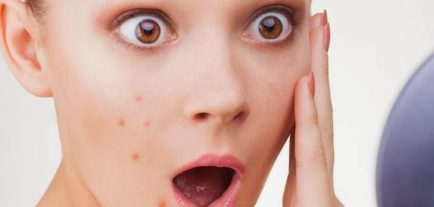 ما أفضل علاج لحب الشباب ما أفضل علاج لحب الشباب