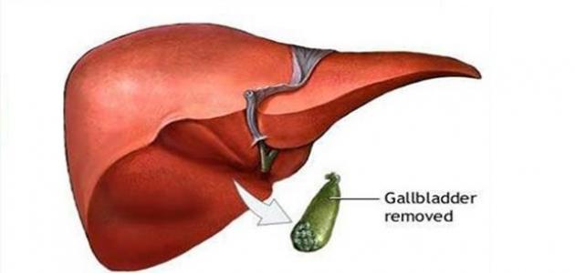 ما بعد عملية المرارة ما بعد عملية المرارة
