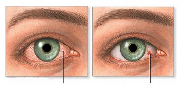 ما سبب اصفرار العين