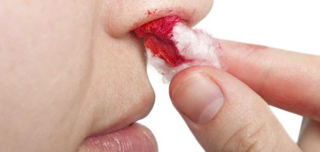 ما سبب نزول الدم من الأنف ما سبب نزول الدم من الأنف