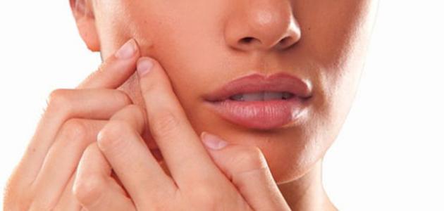 ما علاج الحبوب في الوجه ما علاج الحبوب في الوجه