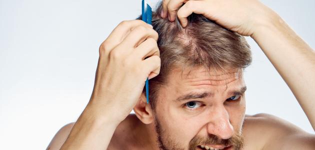 ما علاج الصلع ما علاج الصلع