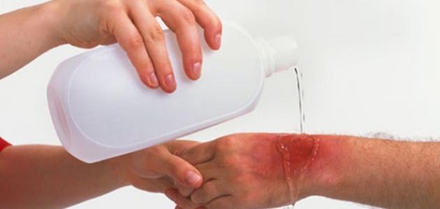 ما هو أفضل علاج للحروق ما هو أفضل علاج للحروق