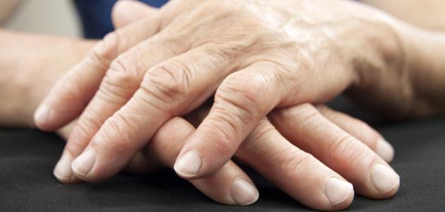 ما هو تحليل الروماتيزم ما هو تحليل الروماتيزم