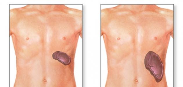 ما هو تضخم الطحال ما هو تضخم الطحال