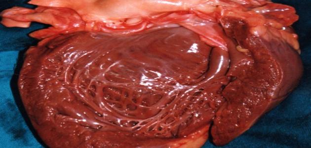 ما هو تضخم القلب ما هو تضخم القلب