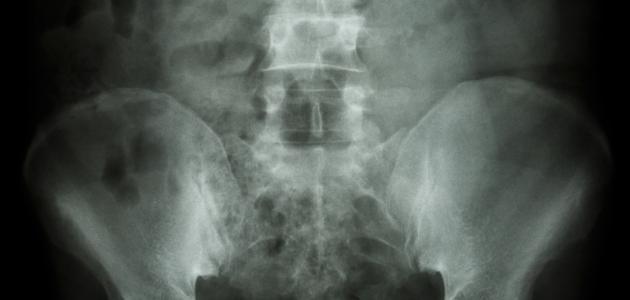 ما هو تكلس العظام ما هو تكلس العظام