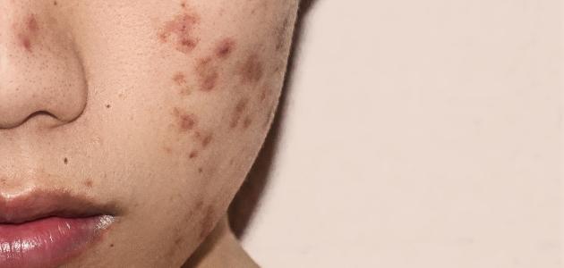 ما هو حب الشباب ما هو حب الشباب