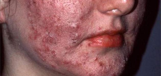 ما هو داء الحفر ما هو داء الحفر