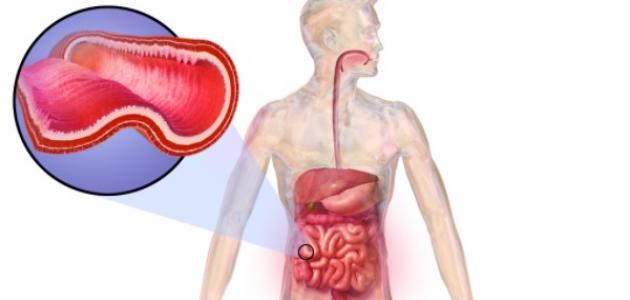 ما هو داء كرون