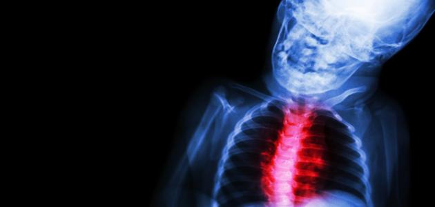 ما هو روماتيزم القلب ما هو روماتيزم القلب