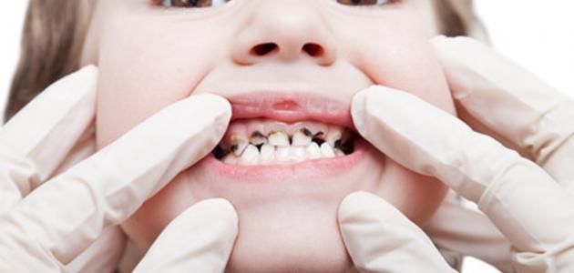 ما هو سبب تسوس الأسنان ما هو سبب تسوس الأسنان