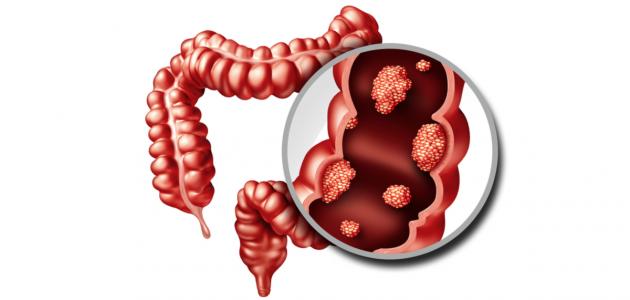 ما هو سرطان القولون